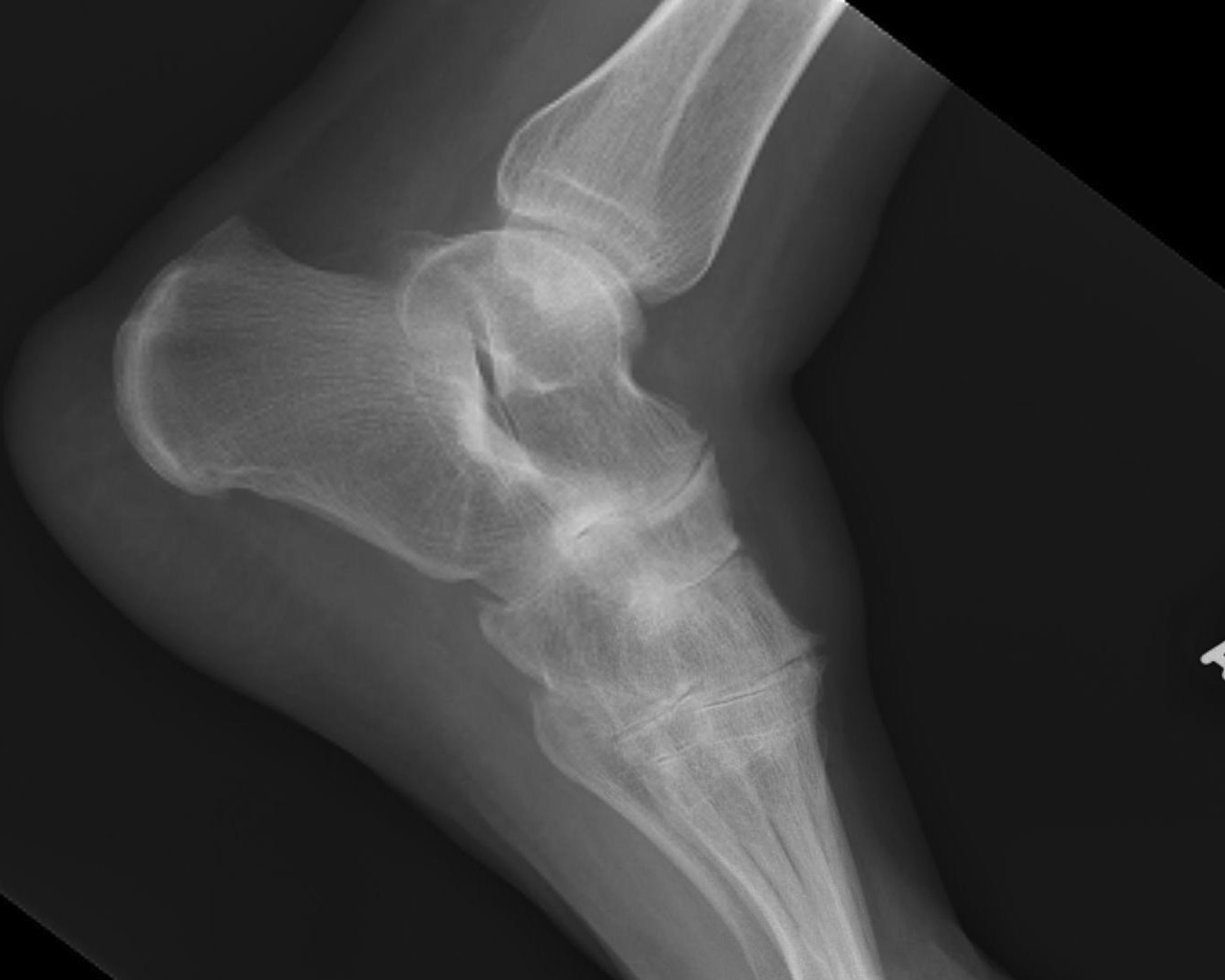 Rheumatoid Midfoot OA